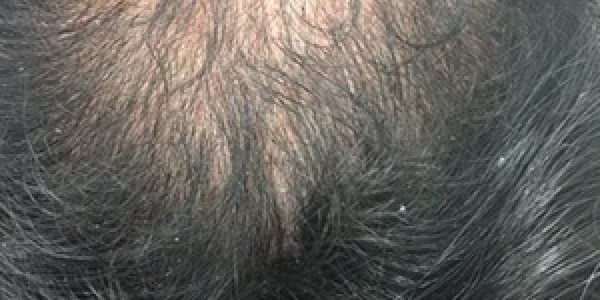 hair-loss-scalp-disorder-before
