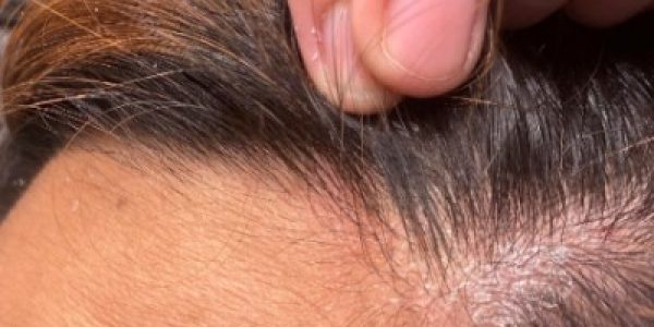scalp-infection-causes-1